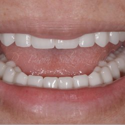 Orange County Prosthodontics - Natural looking dentures. comfortable, functional and very durable with premium teeth.