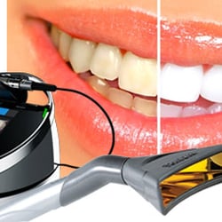 Rancho Bernardo Dental Arts - Our in office Laser Whitening! Ask about our specials!
