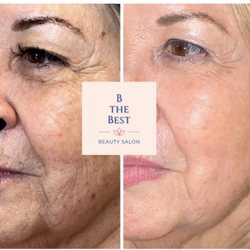 Fibroblast plasma skin tightening on the whole face