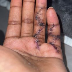 Swift Institute Hand Therapy - Healing of the scars.