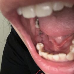Oral & Facial Surgery Center of Virginia - Like why is there cuts on my tongue and look like a great incision to pull the tooth straight out but yet you take my molar out ?????