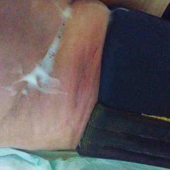 West Boca Medical Center - The nurses let feces drip put of her diaper on to her leg brace and said they cleaned the brace but you see fecal.matter in the seams - Medical Centers Near Me - Boca Raton, Florida