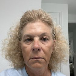 Illume Medical Spa - After treatment 2.5 weeks.