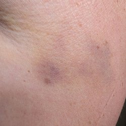 Asgard Massage - Bruise's she left on shoulder