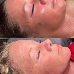 GANZ Beauty - Mircochanneling before and after 4 treatments