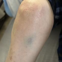 Chico Terrace Care Center - This leg got a bruise, no bandage. We have no idea what the other leg has since they have a huge bandage on