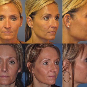 Mark Checcone - RejuveFace - Medical Spas Near Me - Sarasota, Florida Mark Checcone - RejuveFace - Medical Spas Near Me - Sarasota, Florida