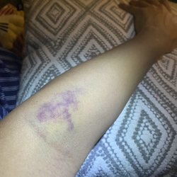 West Pacific Medical Laboratory - My arm two days after getting blood drawn