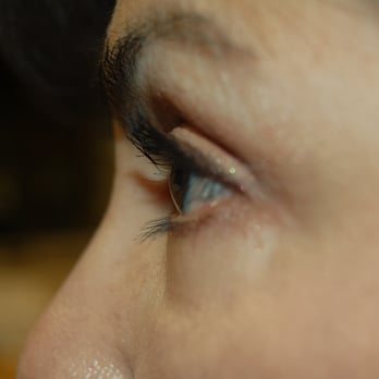 Craig E. Berris, MD - After Upper & Lower Blepharoplasty (Eyelids) - Cosmetic Surgeons Near Me - Sacramento, California
