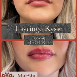 MarSha MedSpa - LIP FILLER SPECIAL! BUY 1 SYRINGE KYSSE , GET $100 OFF PLUS 50 UNITS FREE DYSPORT!
