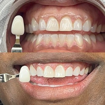 The Coco Blanc Teeth Whitening - Teeth Whitening Near Me - Whittier, California The Coco Blanc Teeth Whitening - Teeth Whitening Near Me - Whittier, California