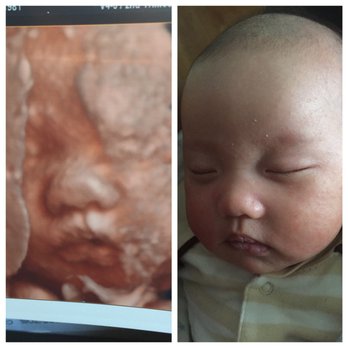 3D-4D Ultrasound Studio Queens - Before and after of my chunky monkey! - Diagnostic Imaging Near Me - Flushing, New York