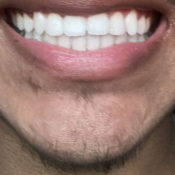 Eagle Rock Smile - Composite bonding - General Dentistry Near Me - Los Angeles, California Eagle Rock Smile - Composite bonding - General Dentistry Near Me - Los Angeles, California