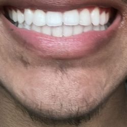 Eagle Rock Smile - Composite bonding