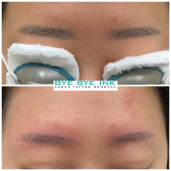 Bye Bye Ink - They're not all one session but these are! - Tattoo Removal Near Me - Middle Village, New York Bye Bye Ink - They're not all one session but these are! - Tattoo Removal Near Me - Middle Village, New York
