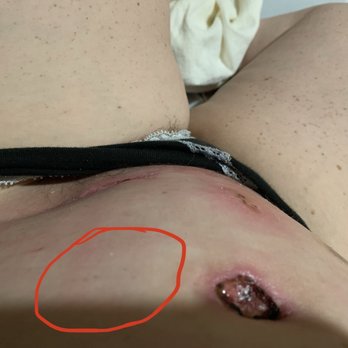 Grace George Thomas MD - Botched plastic surgery. The care has been awful. He can obviously *not* feel my pain, but what's circled is an area that is hard as a rock. - Cosmetic Surgeons Near Me - Catonsville, Maryland