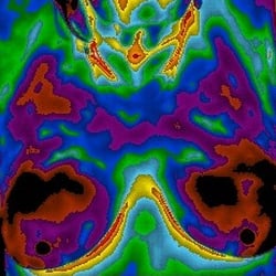 Brentwood Thermography Proactive Wellness & Imaging Center - One of our client's Breast Thermogram - Healthy Breasts