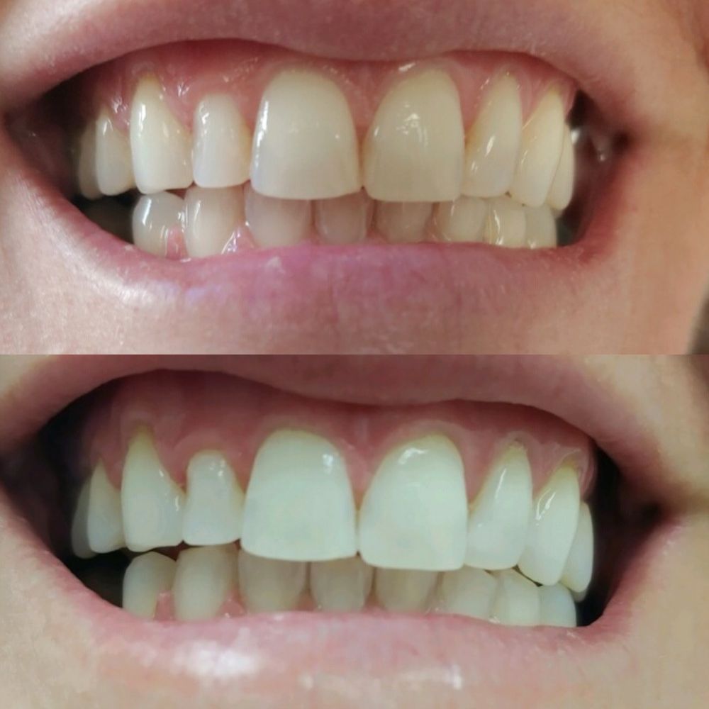 Teeth Whitening by Tovani Logo