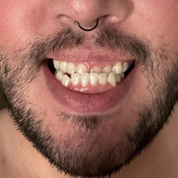 Randy Rosales, DDS - Before - Cosmetic Dentists Near Me - Orange, California
