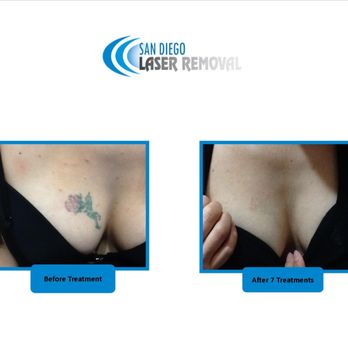 ぽこあぽこ THE BEST 10 TATTOO REMOVAL near ALPINE, CA 91901 - Updated