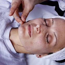Aram Akopyan, MATCM LAc Dipl OM - We offer Acufacial services for facial rejuvenation