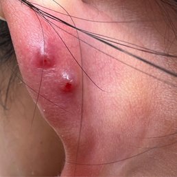 Due to poor practice. Hoops were never properly closed by piercer, there was a gap and my ear "healed" around it. Due to poor practice. Hoops were never properly closed by piercer, there was a gap and my ear "healed" around it.