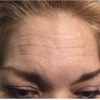 Botox Boutique - Picture taken before forehead botox. - Skin Care Near Me - Sunnyvale, California Botox Boutique - Picture taken before forehead botox. - Skin Care Near Me - Sunnyvale, California