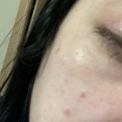 Sonic Skin Care - Atrophic scarring (top) deeper and bottom (slightly)