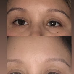 Napa Solano MediSpa - 1st pic was in 2020 before PRP. The 2nd picture May 2022 2nd treatment of PRP, 6 days after treatment.