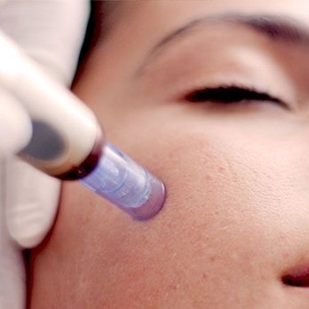 Island Massage Therapy - What is Microneedling good for? The purpose of treatment is to generate new collagen and skin tissue for smoother, firmer, more toned skin. - Skin Care Near Me - Clearwater, Florida Island Massage Therapy - What is Microneedling good for? The purpose of treatment is to generate new collagen and skin tissue for smoother, firmer, more toned skin. - Skin Care Near Me - Clearwater, Florida
