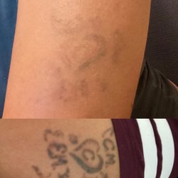 Abbey Aesthetics - Top = Results after 4 sessions Bottom= Original tattoo