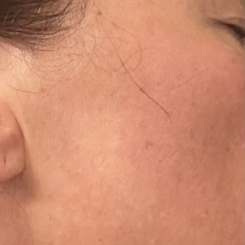 Glow DermSolutions - Post chemical peel - Medical Spas Near Me - San Jose, California Glow DermSolutions - Post chemical peel - Medical Spas Near Me - San Jose, California