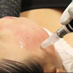 DermCARE Practitioners - Collagen Induction Therapy/Microneedling is GREAT for acne scars and overall rejuvenation