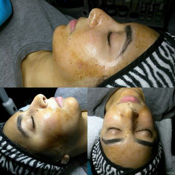 Expertise Esthetics - Microdermabrasion and Pomegranate Enzyme Peel treatment. - Skin Care Near Me - Dallas, Texas