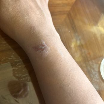 LaserAway - Tattoo Removal Near Me - Austin, Texas