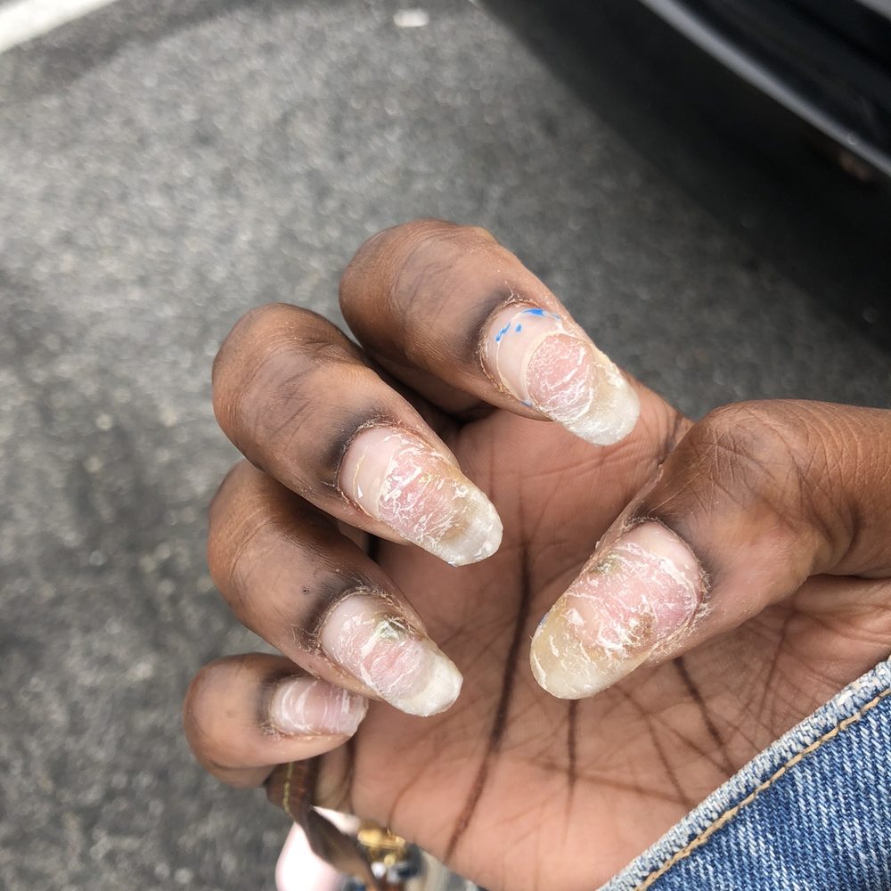 Allure Nails Spa - After the acrylic was RIPPED off my nails - Nail Salons Near Me - Capitol Heights, Maryland Allure Nails Spa - After the acrylic was RIPPED off my nails - Nail Salons Near Me - Capitol Heights, Maryland