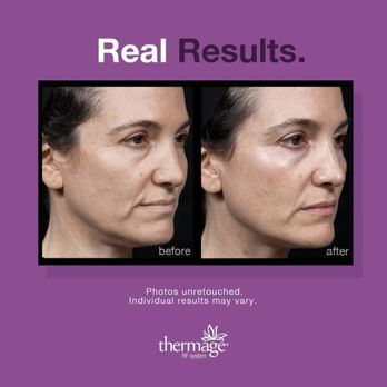 Oya Aesthetics Center - Thermage face tightening treatment - Medical Spas Near Me - Rowland Heights, California Oya Aesthetics Center - Thermage face tightening treatment - Medical Spas Near Me - Rowland Heights, California