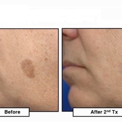 Medlaser - Age Spot