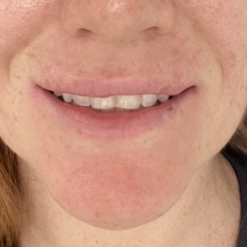 VIOR Life & Aesthetics - After the second injection it looked less botched, but I was still very unhappy with the results. - Medical Spas Near Me - Miami, Florida VIOR Life & Aesthetics - After the second injection it looked less botched, but I was still very unhappy with the results. - Medical Spas Near Me - Miami, Florida