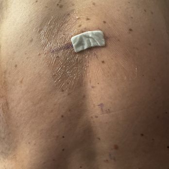 Gregory D Lopez, MD - After a 2 hour thoracic T8, T9 microdiscectomy surgery - Orthopedists Near Me - Naperville, Illinois Gregory D Lopez, MD - After a 2 hour thoracic T8, T9 microdiscectomy surgery - Orthopedists Near Me - Naperville, Illinois