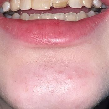 Pediatric Dental Group - Glens Falls - Both of my front teeth looked like this. "We'll see you in 6 months" I ended up finding a new dentist who fixed my teeth perfectly - Pediatric Dentists Near Me - Glens Falls, New York Pediatric Dental Group - Glens Falls - Both of my front teeth looked like this. "We'll see you in 6 months" I ended up finding a new dentist who fixed my teeth perfectly - Pediatric Dentists Near Me - Glens Falls, New York