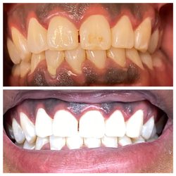 Before and after