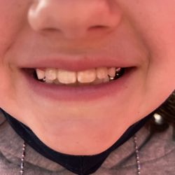 SmileyCuse - Day braces were removed!!!