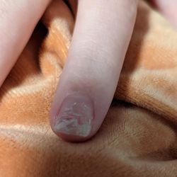 Star Nails & Spa - Damage to one of the nails,.many have similar damage