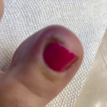 Executive Nails & Spa - Rosenberg - Infected toenail with pus coming out of it - Nail Salons Near Me - Rosenberg, Texas Executive Nails & Spa - Rosenberg - Infected toenail with pus coming out of it - Nail Salons Near Me - Rosenberg, Texas