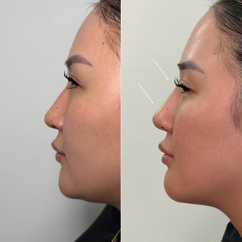 Biolite Wellness - Non-Surgical Nose Filler - Medical Spas Near Me - Irvine, California Biolite Wellness - Non-Surgical Nose Filler - Medical Spas Near Me - Irvine, California
