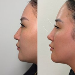Biolite Wellness - Non-Surgical Nose Filler