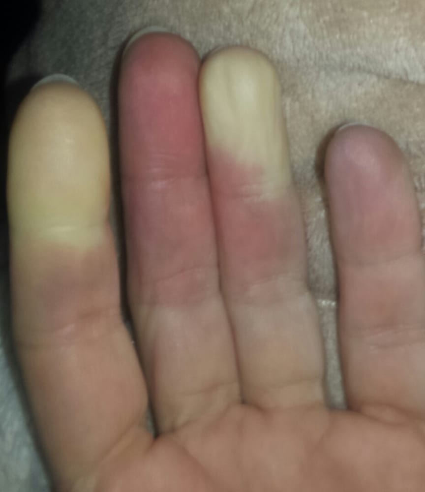 My Hand While Waiting For Mri Results Admitting Notes Read No