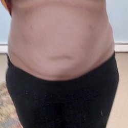 Park Avenue - No difference after 3 months, plus 2 little scars on the top of the fat