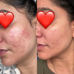 Skincare by Anna - Before/after